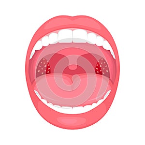 Throat bacterial infection, tonsils inflammation.