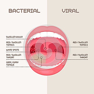 Throat bacterial infection, tonsils inflammation.