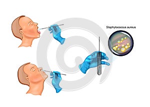 Throat and nose swab photo