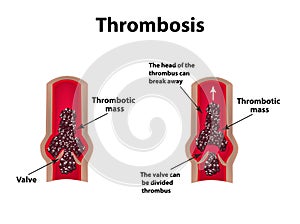 Thrombocytosis. Embolism. Infographics. Vector illustration on isolated background