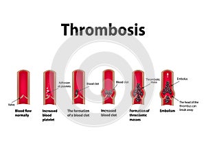 Thrombocytosis. Embolism. Infographics. Vector illustration on isolated background