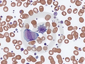 Thrombocytosis, myeloblast and giant platelet.
