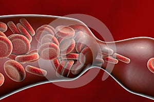 Thromboembol in blood vessel