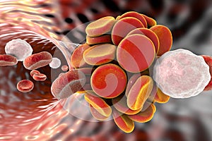 Thromboembol in blood vessel