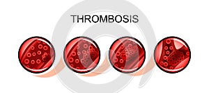 Thromboembolism artery. blockage