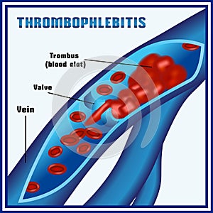 Thrombophlebitis, blood clots in the veins. Embolism. Thrombosis