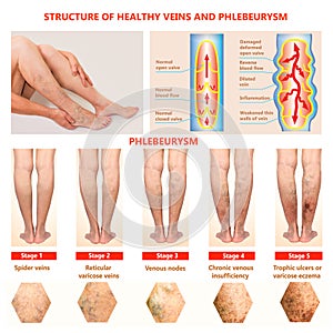 Thrombophlebitis. Deep Vein Thrombosis. Varicose veins