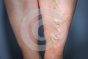 Thrombophlebitis in human leg