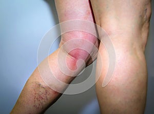 Thrombophlebitis in human leg