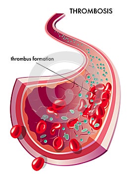 Trombóza 