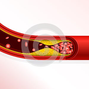 Thrombosis of artery - cholesterol buildup, arteriosclerosis