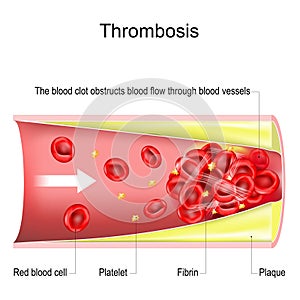 Thrombosis. The blood clot obstructs blood flow through blood vessels