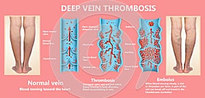 Thrombosis. From Normal blood flow to Blood clot formation