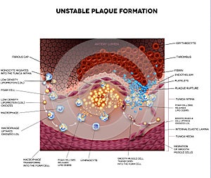 Thrombus, blood clot, unstable plaque photo