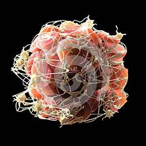 Thrombus in bloodstream, blood clot with activated platelets and fibrin, medically 3D illustration