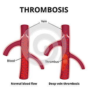 Thrombus formation