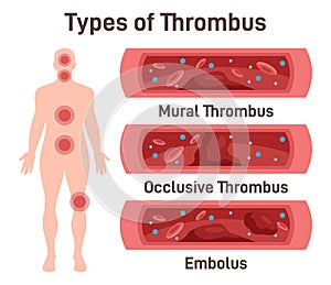 Thrombus types. Arteriosclerosis, infarct, ischemia, thrombosis disease.