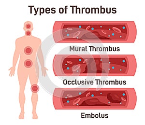 Thrombus types. Arteriosclerosis, infarct, ischemia, thrombosis disease. photo