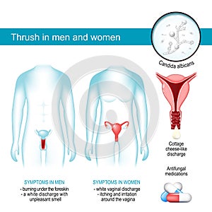 Thrush in men and women. yeast infection