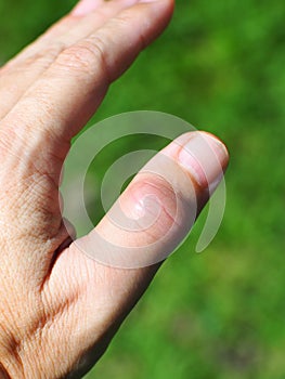 Thumb finger joint get sudden, intense pain in a night like gout