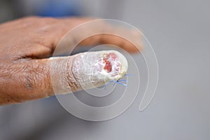 a thumb of the left hand with surgical removal of the thumb nail, and stitches of a cut wound after a direct trauma to the finger