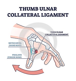 Thumb ulnar collateral ligament as finger injury and problem outline diagram photo