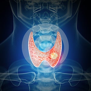 Thyroid cancer