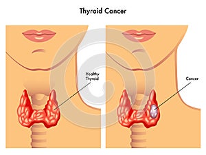 Ghiandola tiroidea cancro 