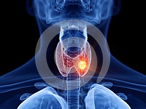 Thyroid cancer