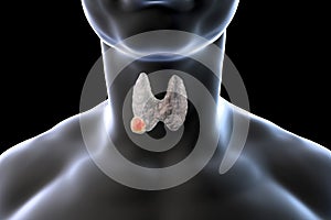 Thyroid cancer. illustration