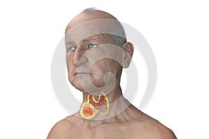 Thyroid cancer, illustration showing tumor inside thyroid gland