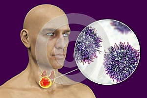 Thyroid cancer, illustration showing tumor inside thyroid gland and closeup view of cancer cells