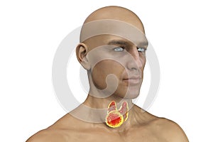 Thyroid cancer in men, illustration showing tumor inside thyroid gland