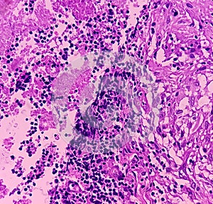 Thyroid cancer: Microscopic image of Follicular neoplasm. Malignant neoplasm of atypical thyroid follicular epithelial cells.