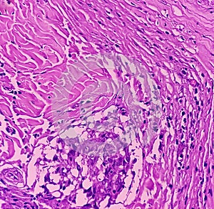 Thyroid cancer: Malignant neoplasm of atypical thyroid follicular epithelial cells. photo