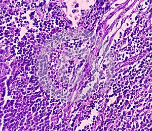 Thyroid cancer: Microscopic image of Metastatic papillary carcinoma of thyroid. Reactive change. Lymph node carcinoma