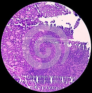 Thyroid cancer: Microscopic image of Metastatic papillary carcinoma of thyroid. Reactive change. Lymph node carcinoma