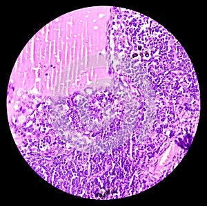 Thyroid cancer: Microscopic image of Metastatic papillary carcinoma of thyroid. Reactive change. Lymph node carcinoma