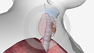 Thyroid Cancer Stage 2 The primary tumor can be any size and the cancer may or may not have spread to lymph nodes,