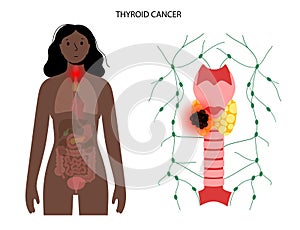 Thyroid cancer stages