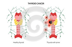 Thyroid cancer stages