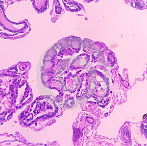 Thyroid cancer. Tracheal gland involved by tumor. Metastatic papillary carcinoma of thyroid. Lymph node carcinoma.