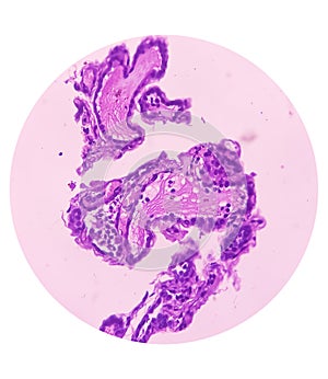 Thyroid cancer. Tracheal gland involved by tumor. Microscopic image of Metastatic papillary carcinoma of thyroid.