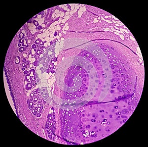 Thyroid cancer. Tracheal gland involved by tumor. Microscopic image of Metastatic papillary carcinoma of thyroid.