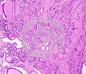 Thyroid cancer. Tracheal gland involved by tumor. Microscopic image of Metastatic papillary carcinoma of thyroid