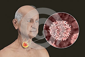 Thyroid cancer, tumor inside thyroid gland
