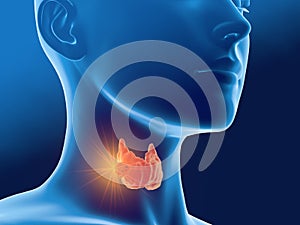 Thyroid cancer of a woman, medically 3D illustration, front view