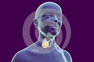 Thyroid cancer in women, illustration showing tumor inside thyroid gland