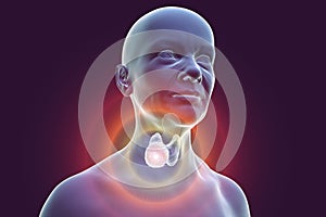 Thyroid cancer in women, illustration showing tumor inside thyroid gland