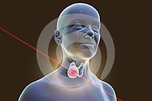 Thyroid cancer in women, illustration showing tumor inside thyroid gland